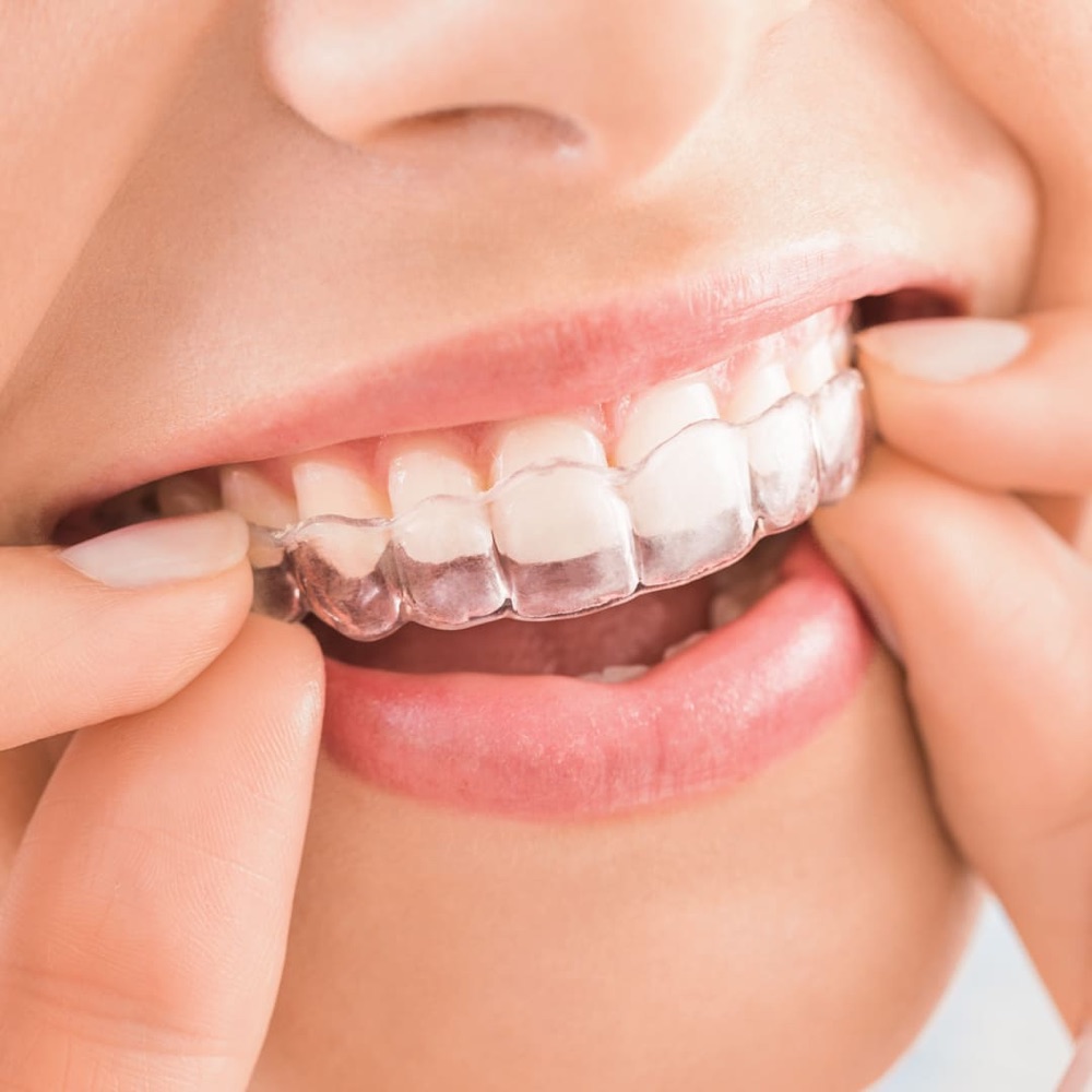 Close-up of a clear aligner being placed